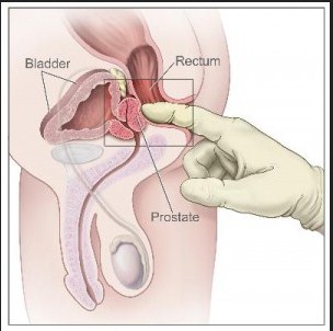 Symptoms of non cancerous and cancerous prostate conditions